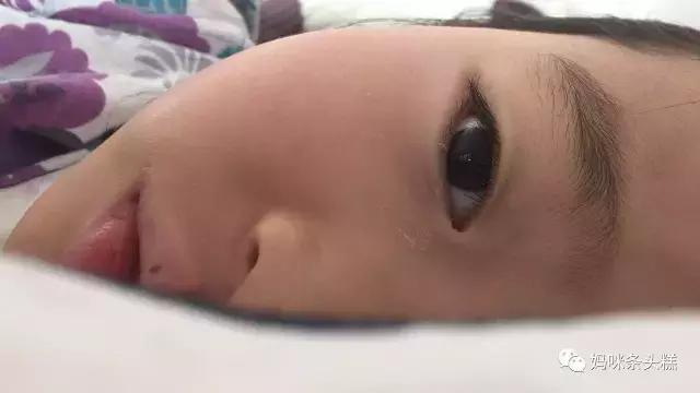 疱疹性咽峡炎亲身经历,儿童疱疹性咽峡炎记录