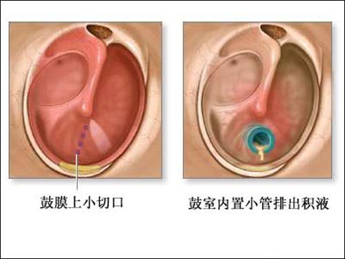 鼓膜穿刺术有后遗症吗,鼓膜穿刺术多少钱