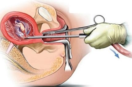 经历了顺产会经历的所有痛,自然分娩产后出血最常见的原因