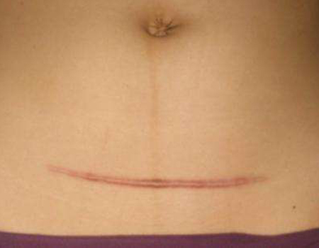 女人剖腹产之后腰疼,女人剖腹产之后的文案