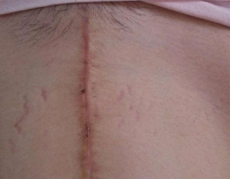 女人剖腹产之后腰疼,女人剖腹产之后的文案