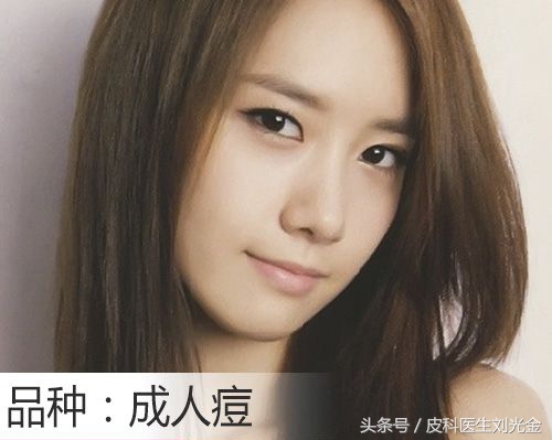 30几岁各种长痘,30多了还在长痘