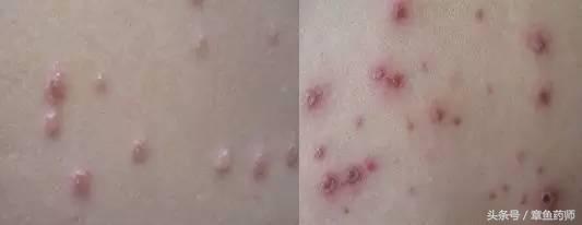 关注水痘高发期这些知识需知,谨慎传染病高发期