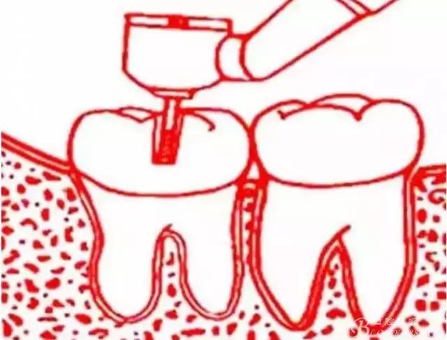 智齿的治疗过程,智齿要上下成对拔除吗