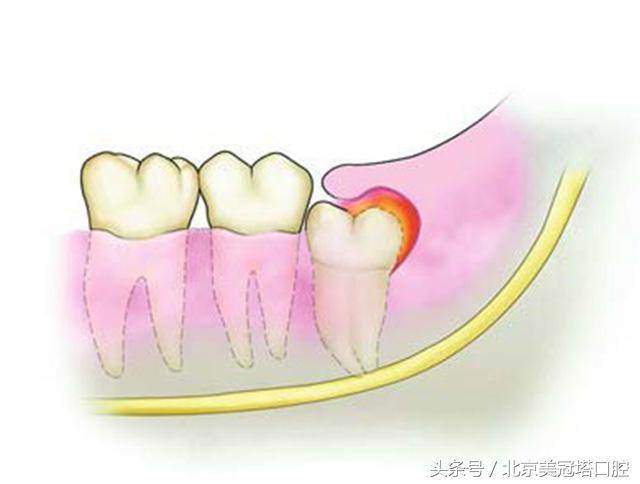 说清楚到底是什么意思,有几种原因引起牙疼
