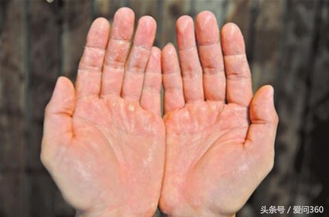 手掌脱皮怎么快速解决,手掌脱皮是怎么回事如何治疗