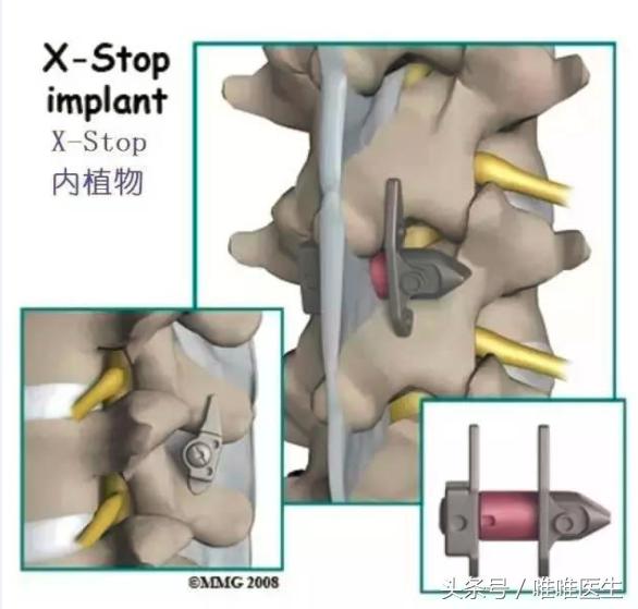 腰椎管狭窄保守治疗怎么治疗,老年腰椎管狭窄的保守治疗法