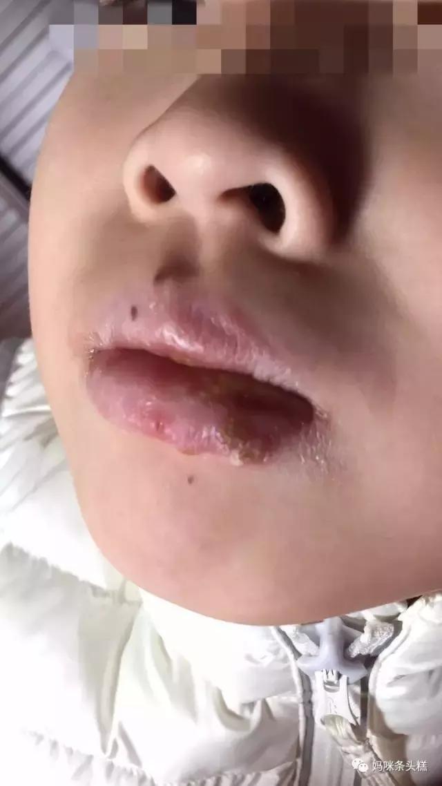 疱疹性咽峡炎亲身经历,儿童疱疹性咽峡炎记录