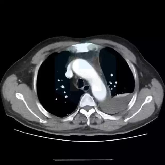 心脏支架后还有胸痛的症状怎么办,心脏支架后还是心绞痛是什么原因
