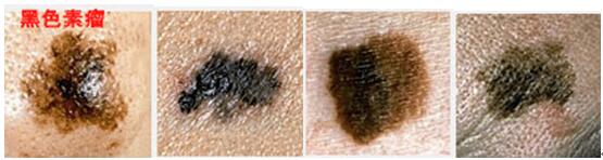 脸上的痣可以随便点吗,小孩脸上有痣可以随便点吗