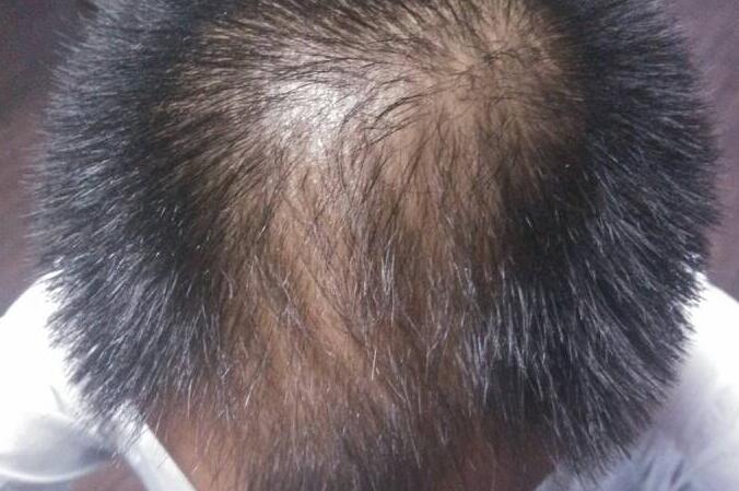 秃顶重新长头发太细怎么改善,秃顶头发稀少怎样掩饰