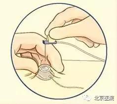 京医科普｜输液港：放心化疗，安心停靠！