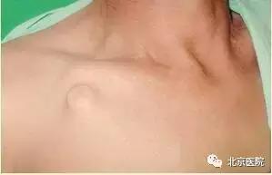 京医科普｜输液港：放心化疗，安心停靠！