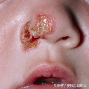 一张图教你辨别脓疱疮,皮肤内脓疱疮最快根除方法