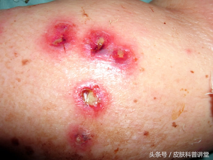 一张图教你辨别脓疱疮,皮肤内脓疱疮最快根除方法