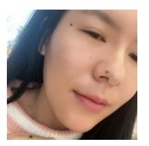 鼻子玻尿酸对比图,玻尿酸填充鼻子变宽后的图片