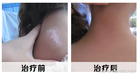 白癜风能自愈吗视频,白癜风能治愈吗白癜风怎么引起的