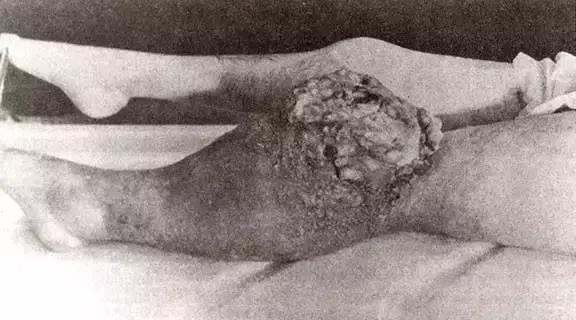 这种物质曾被当作保健成分，受害者的遗骨因此发光上千年