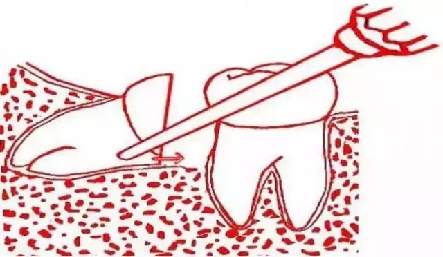 智齿的治疗过程,智齿要上下成对拔除吗