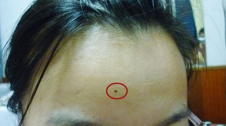 脸上的痣可以随便点吗,小孩脸上有痣可以随便点吗