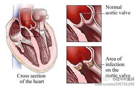 夜间盗汗只有头部出汗,夜间盗汗与棉被厚出汗有何区别