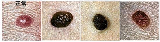 脸上的痣可以随便点吗,小孩脸上有痣可以随便点吗