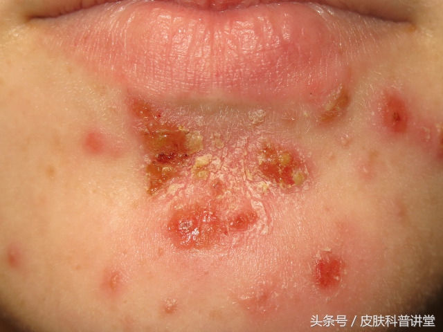 一张图教你辨别脓疱疮,皮肤内脓疱疮最快根除方法