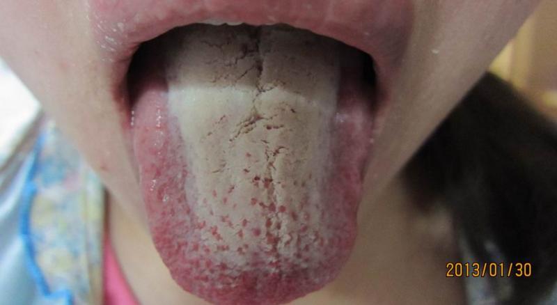 舌苔厚白大便不成形中药调理,舌苔白黄大便不通畅吃什么中成药