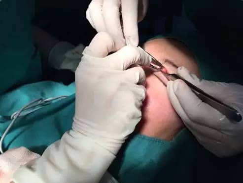 双眼皮怎么割没肉条感,双眼皮怎么显得更宽