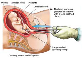 人流手术中胎儿是怎么被取出来的？看了这几张图片你还狠得下心吗
