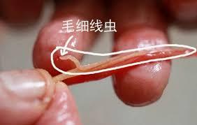 生肉去除寄生虫最好的办法,长期吃生肉18条寄生虫