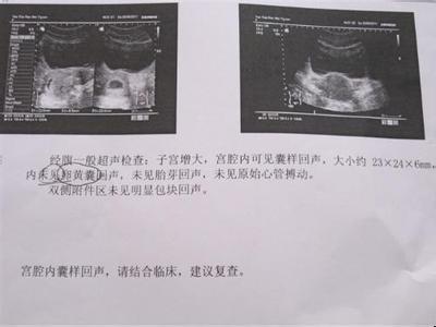宫外孕有哪些症状？异位妊娠要关注，否则一身麻烦