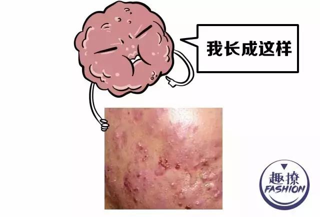 angelababy痘痘,angelababy额头冒巨痘