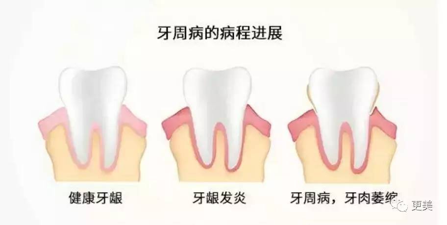 洗牙后牙缝变大松动错位,洗牙后牙齿松动的的亲身经历