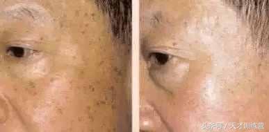 喝了这碗水脸上斑点去无踪！