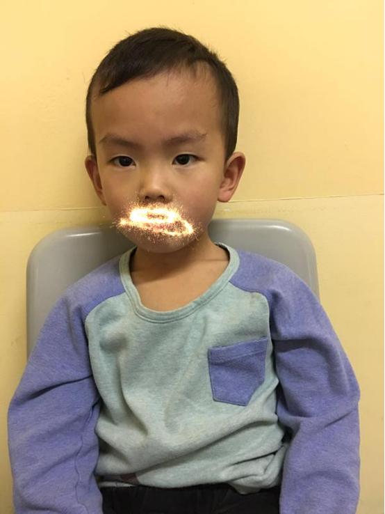 央视报道梅花针治疗远视性弱视,梅花针治疗弱视靠谱吗