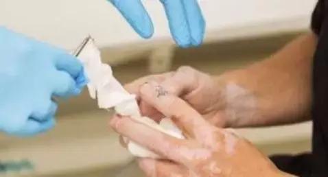 白癜风2021有什么新突破,白癜风最新突破消息