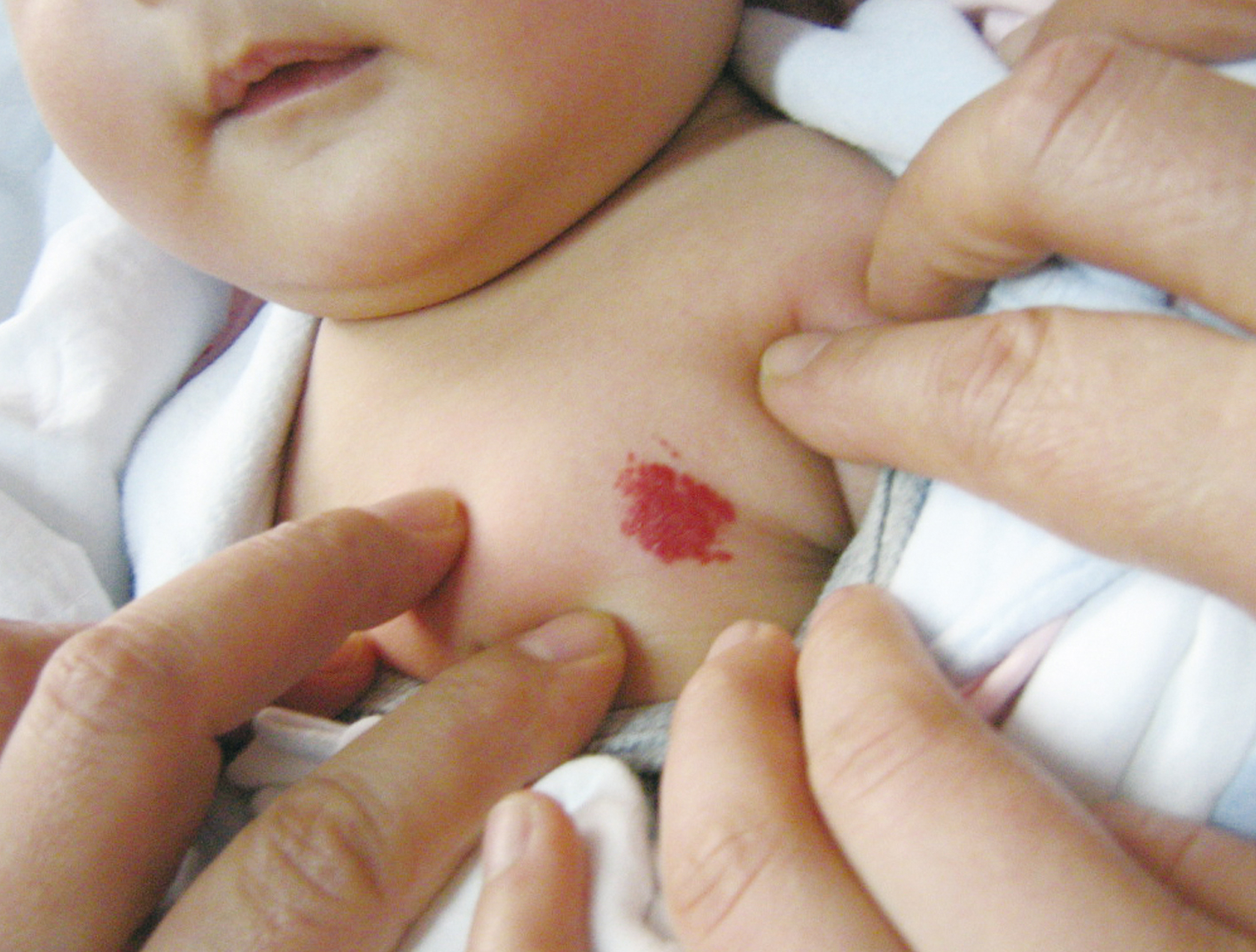 新生儿额头有块红的是啥,新生儿额头出现一片泛红