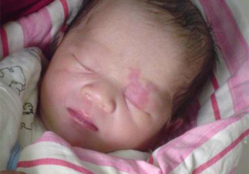 为什么说靠药品去除不了胎记