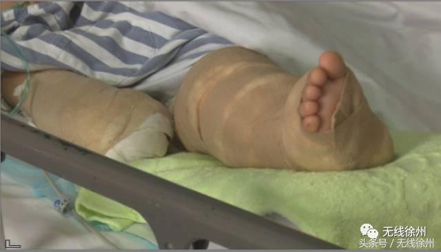 3岁女童被烧成火人！不到半个月徐州一医院已经接了4例！