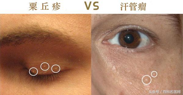 眼霜太油长颗粒,眼霜太滋润会有脂肪粒吗