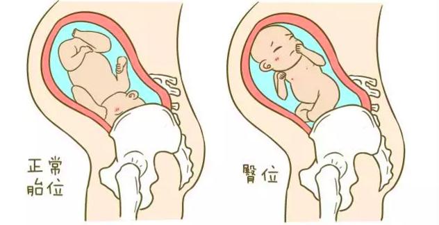 胎位不正漫步有利于转正胎位吗,胎位不正医生手动转正胎位