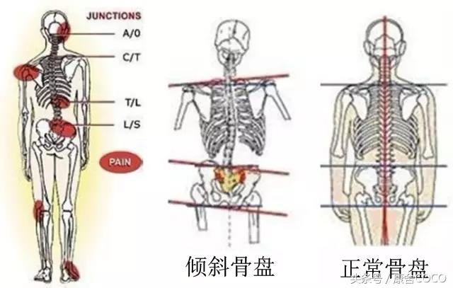 骨盘倾斜引起的妇科疾病！（产后骨盘复位是如此的重要）