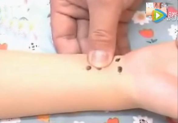 湘西点穴治疗脑瘫的名医,小儿脑瘫推拿疗法