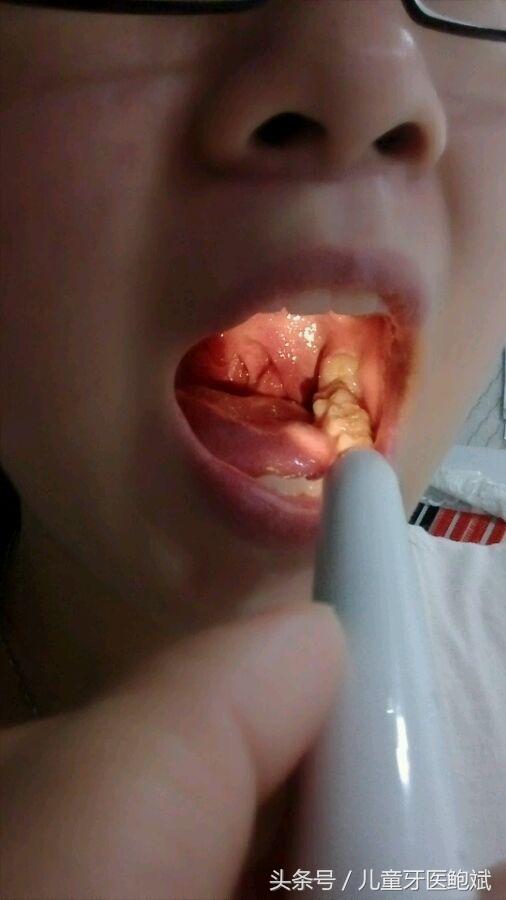 小朋友牙缝怎么清洁,大家怎么清理口腔