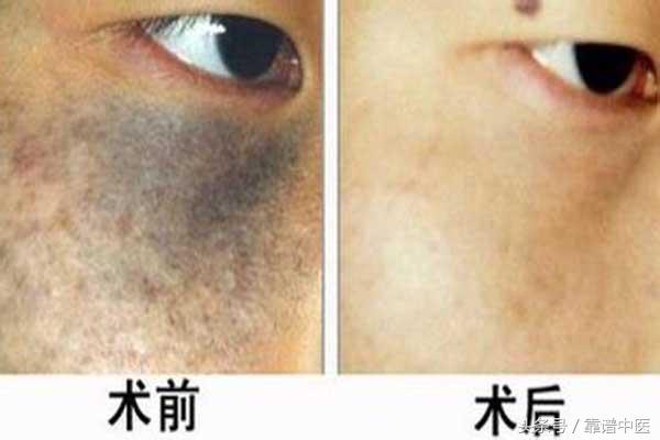 颧骨上长一块黑斑是怎么回事,老人脸上有黑斑怎么回事