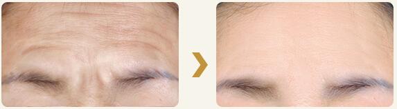 额头不饱满有抬头纹怎么办,额头有很明显的抬头纹怎么办