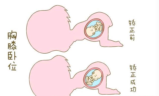 胎位不正漫步有利于转正胎位吗,胎位不正医生手动转正胎位