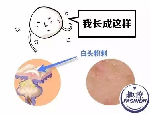 angelababy痘痘,angelababy额头冒巨痘