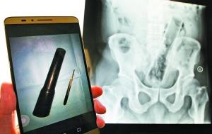 杭州男子肛门被塞20公分长振动棒称年会被恶搞（图